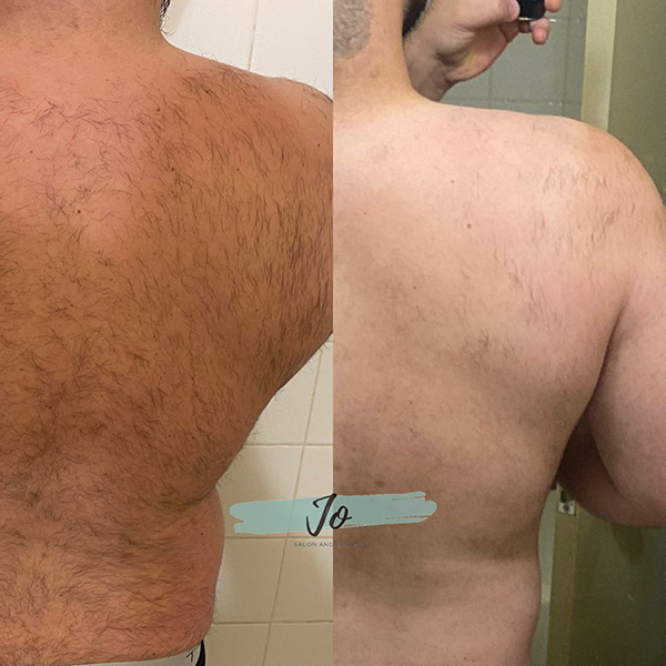 Laser hair discount removal results